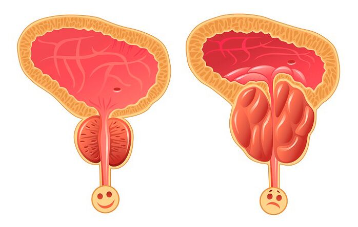 Normální a zanícená prostata