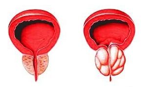 Prostata v normálním stavu (vlevo) a zanícená prostatitidou (vpravo)