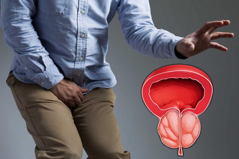 Prostatitida u muže vyžadující okamžitou léčbu