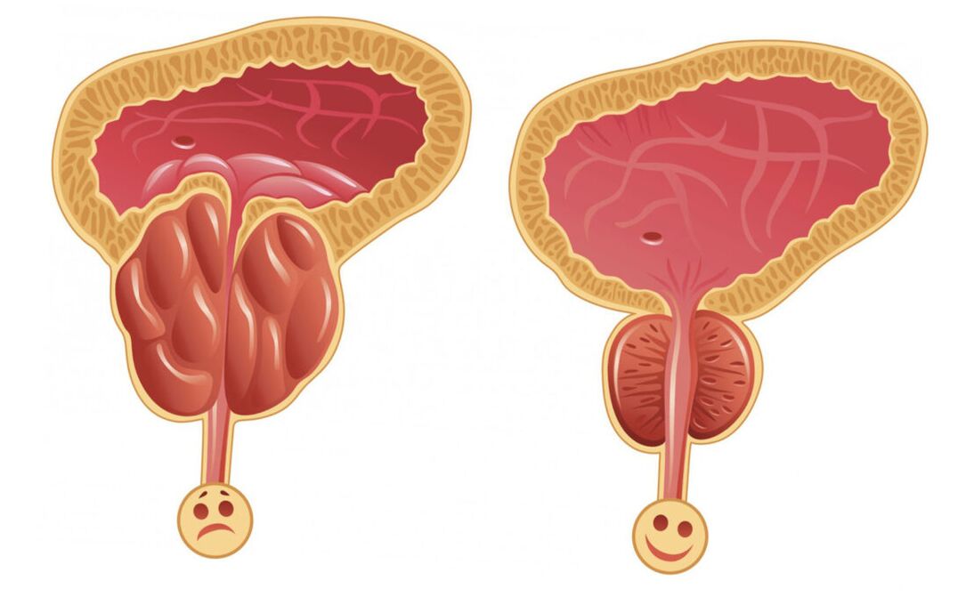 Zánět prostaty s prostatitidou (vlevo) a prostata je normální (vpravo)